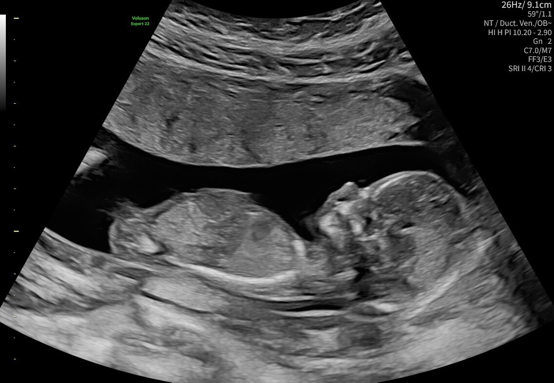 Gender Reveal