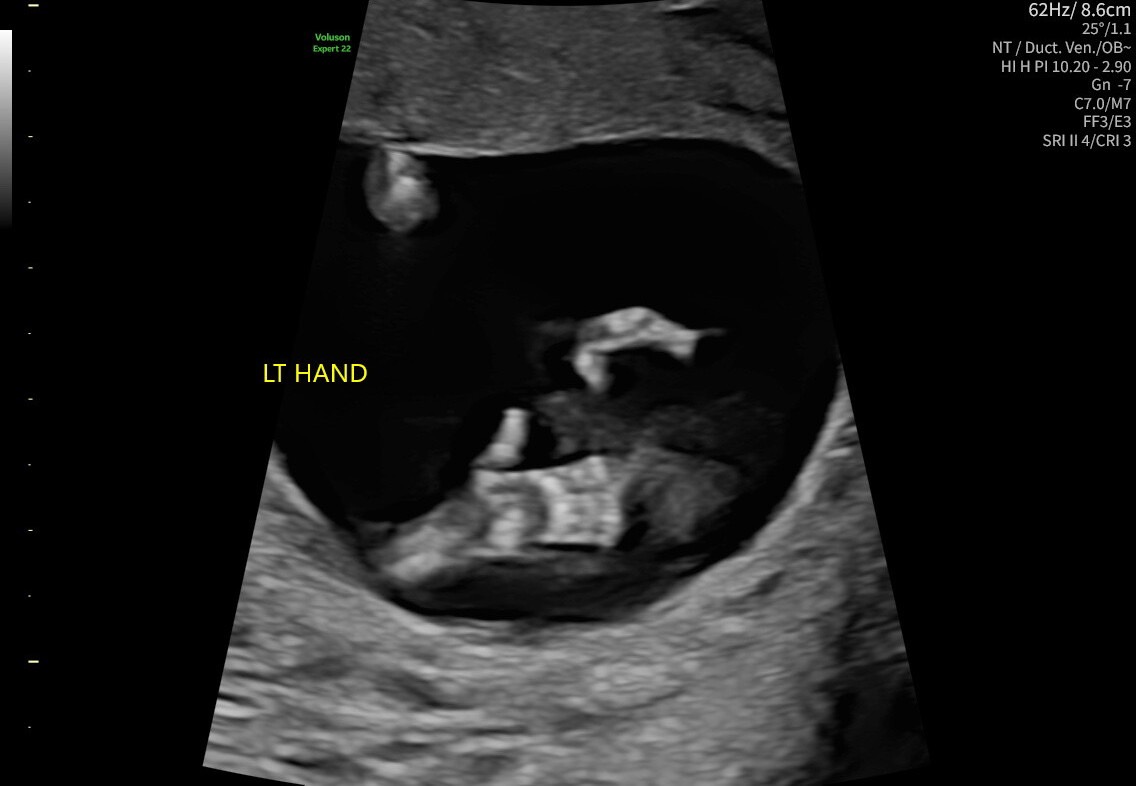 Ultrasound Images