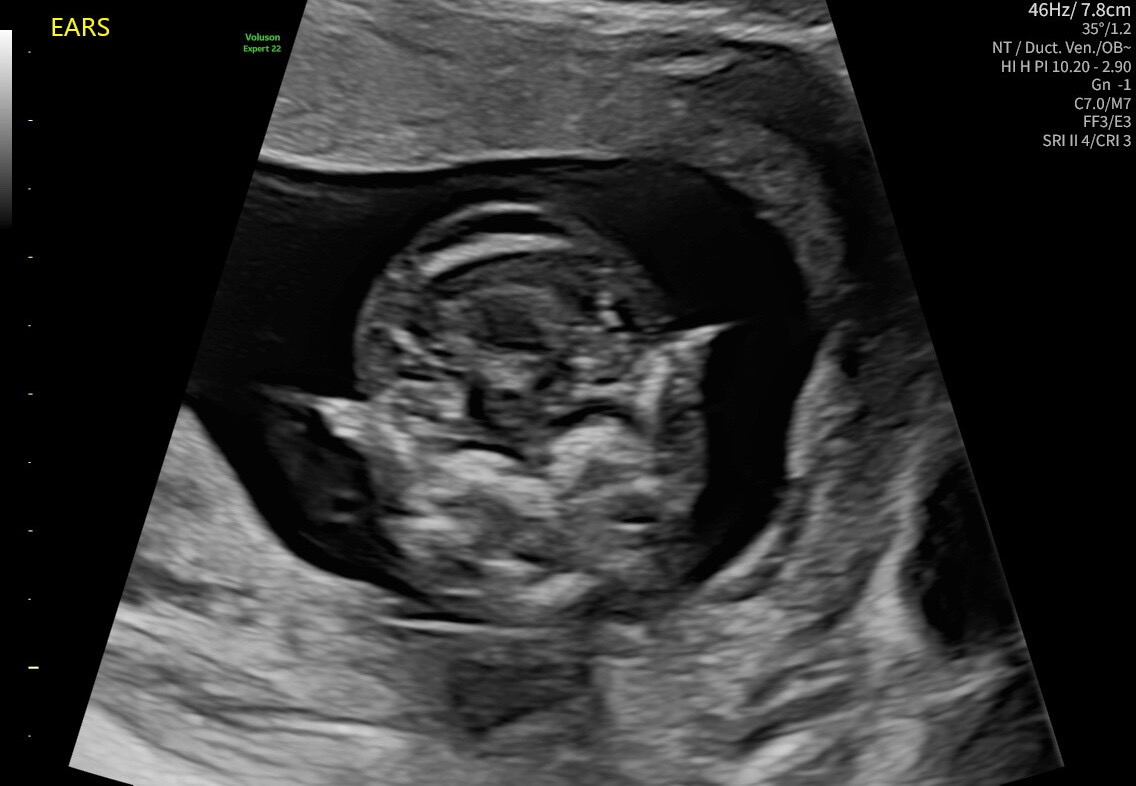 Ultrasound Images